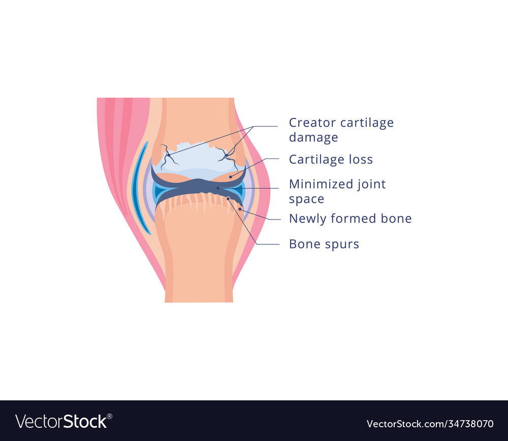 Knee joint damage with osteoarthritis flat