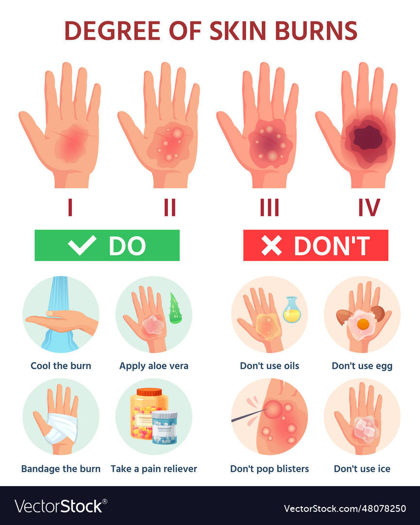 Burns degree first aid for burn wound fire damage Vector Image