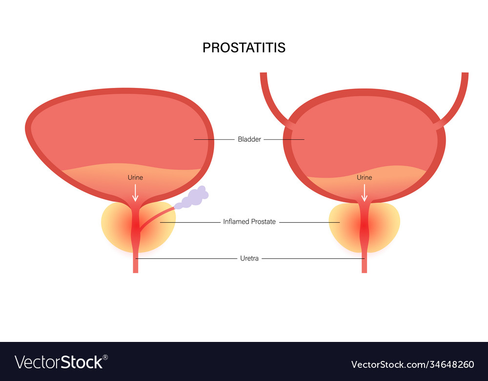 Prostatitis inflammation problem