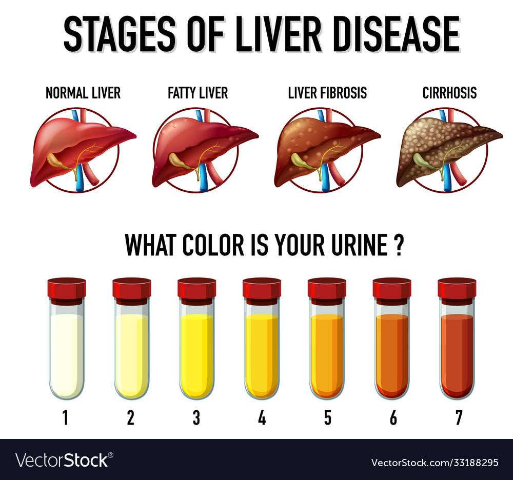 Stages liver disease Royalty Free Vector Image