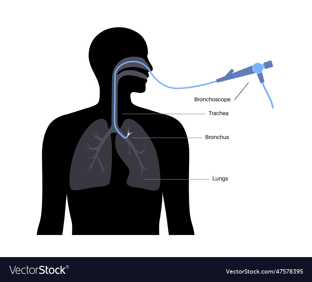 Bronchoscopy Procedure Concept Royalty Free Vector Image