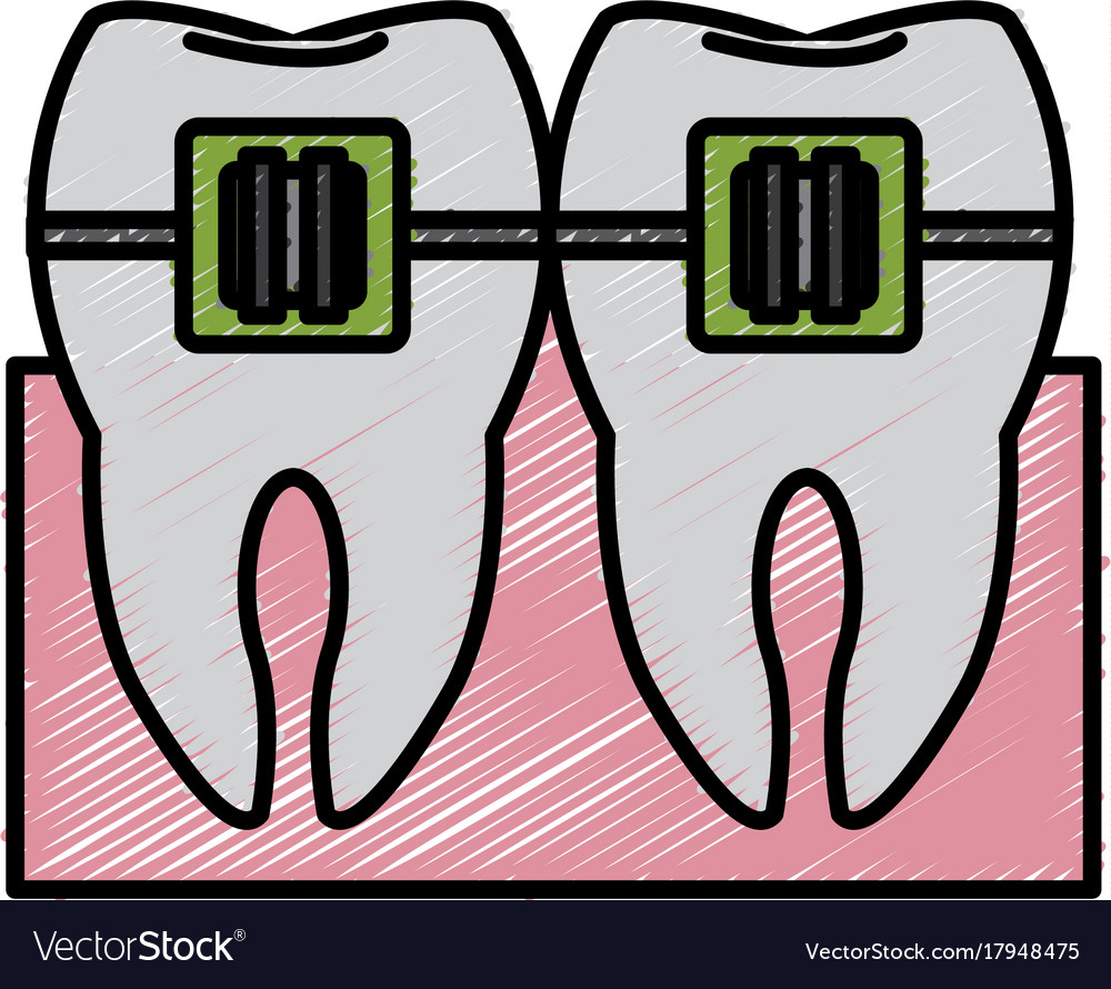 Tooth with bracket Royalty Free Vector Image - VectorStock
