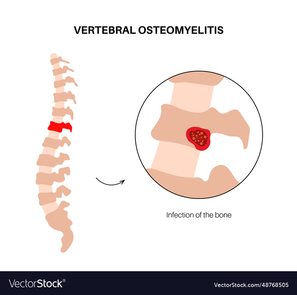 Vertebral osteomyelitis poster Royalty Free Vector Image