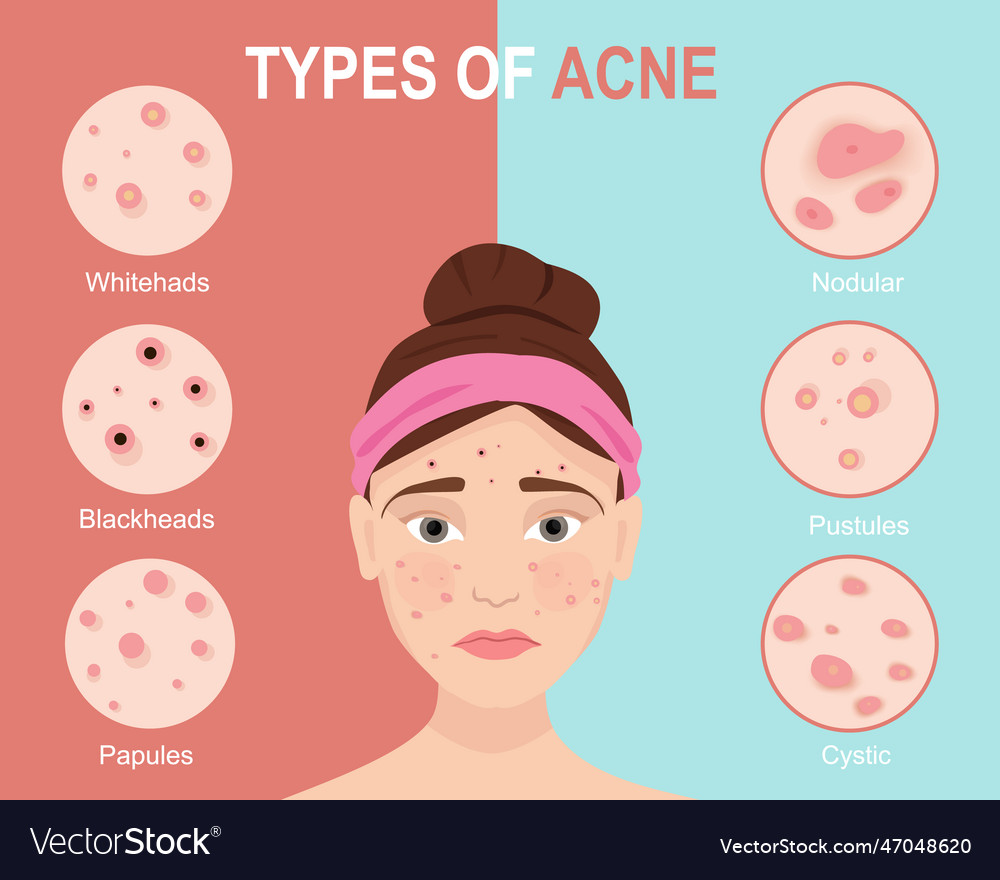 Types of acne skin problems Royalty Free Vector Image