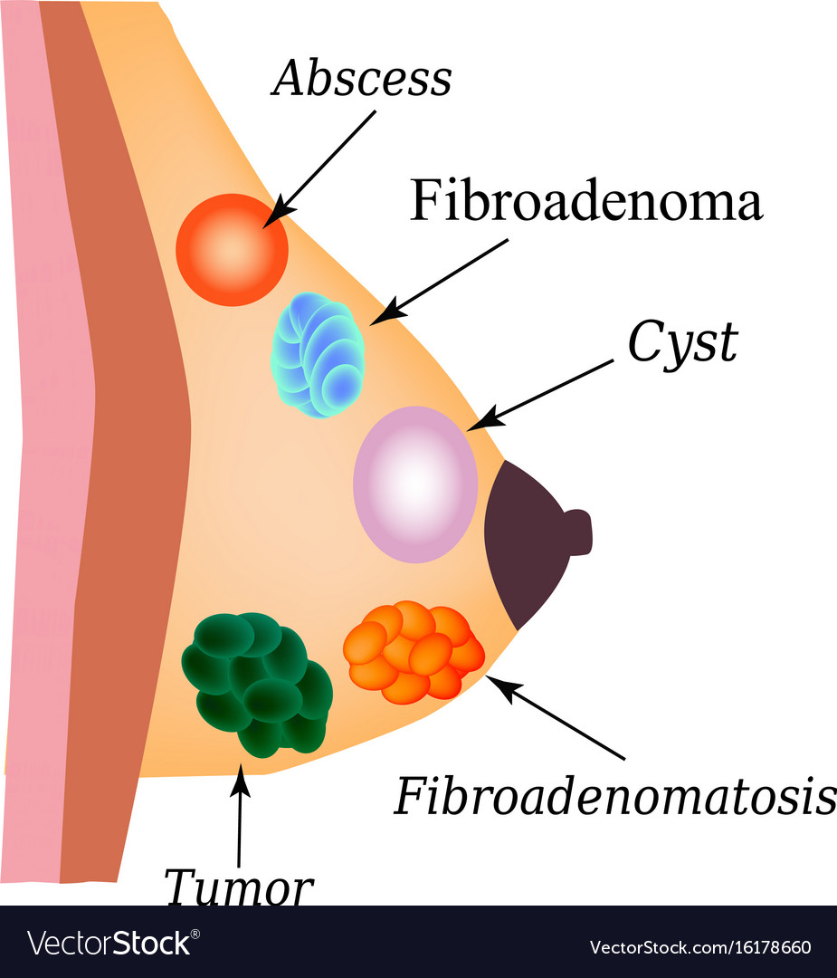 fibroadenoma