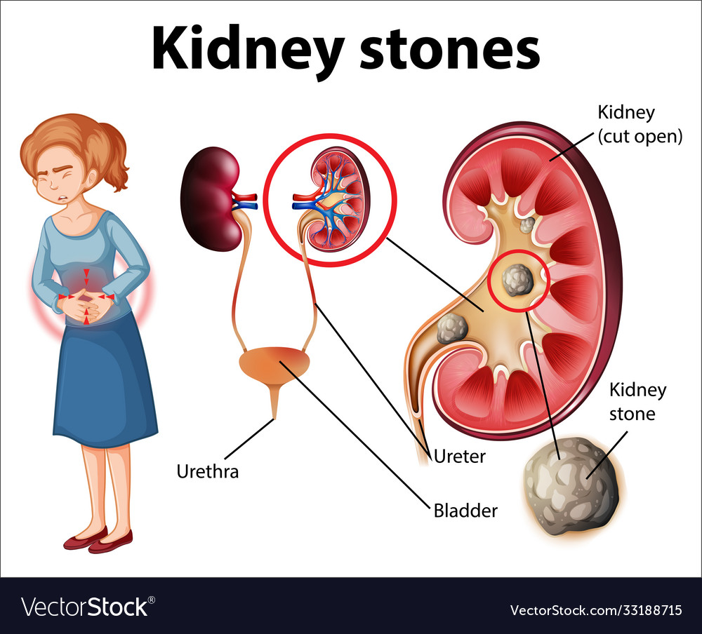 Informative kidney stones Royalty Free Vector Image