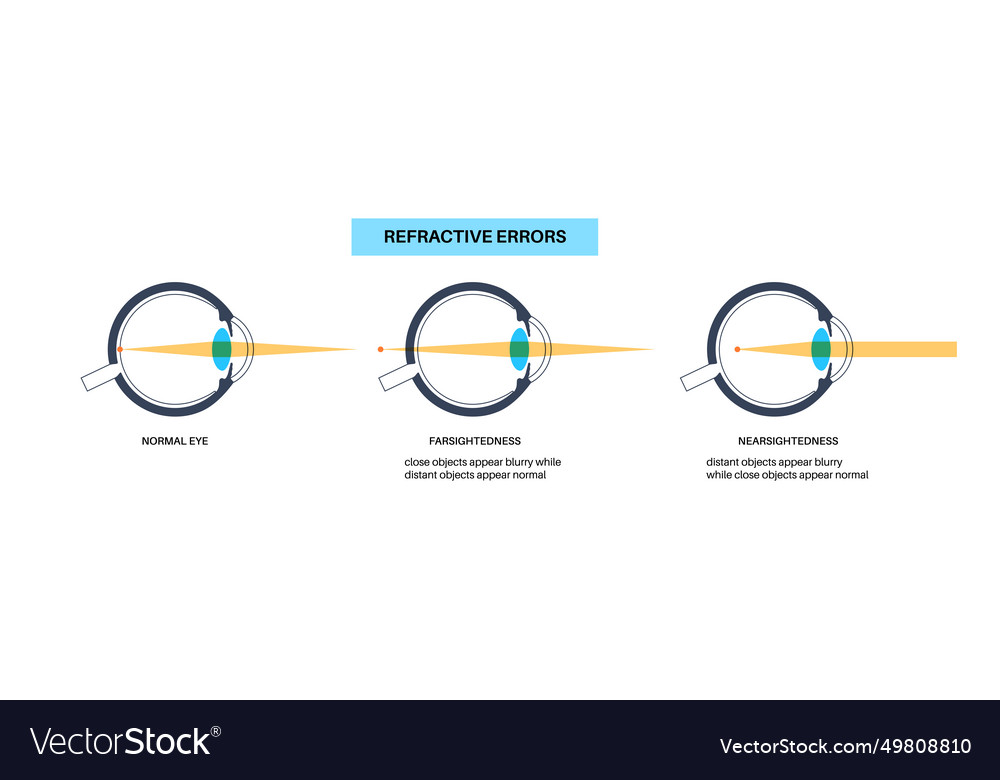 Farsightedness and nearsightedness Royalty Free Vector Image