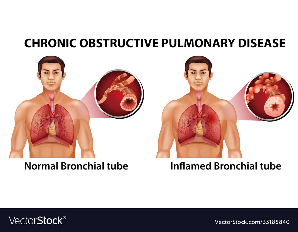 Chronic obstructive pulmonary disease