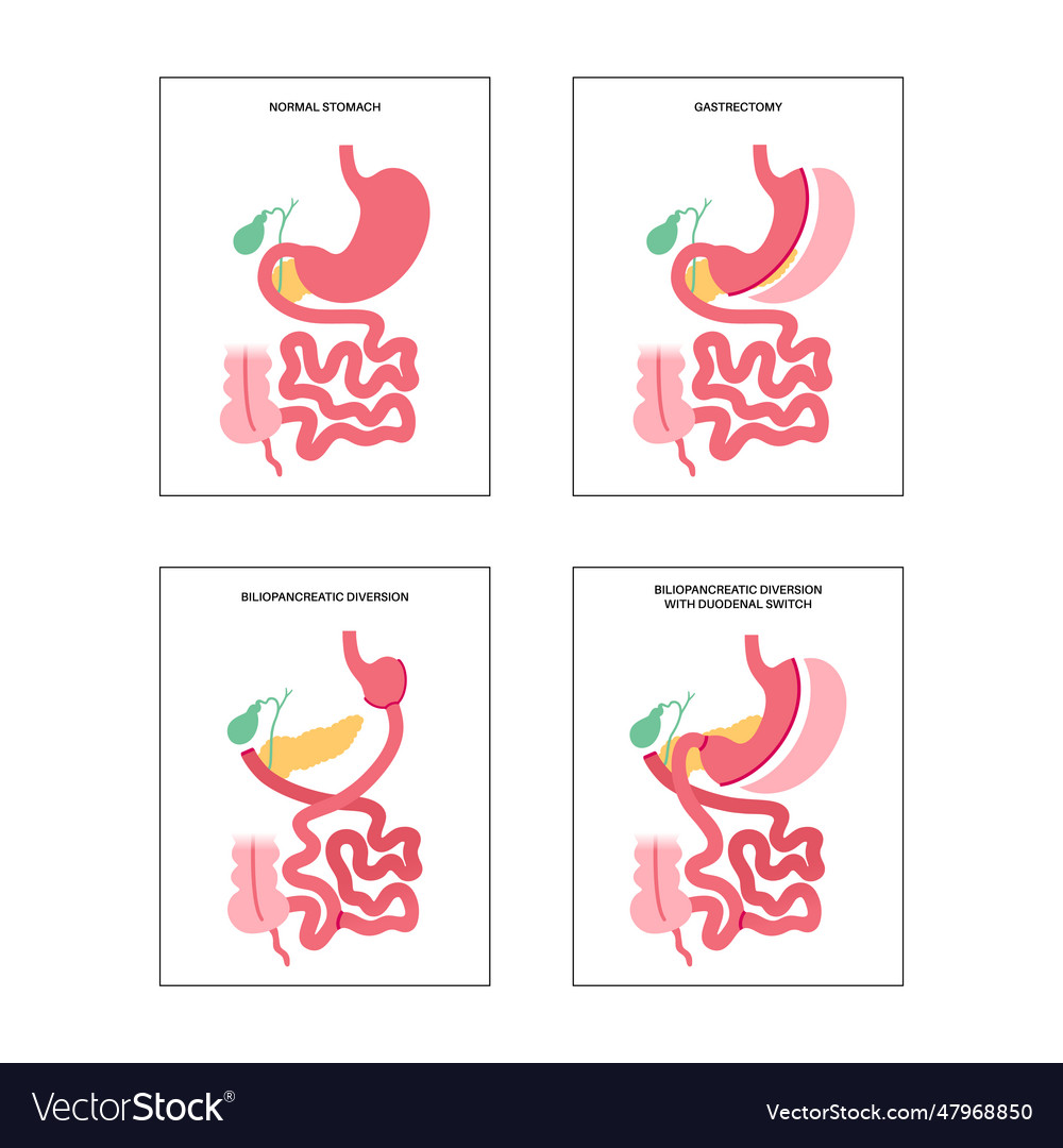 Bariatric surgery poster