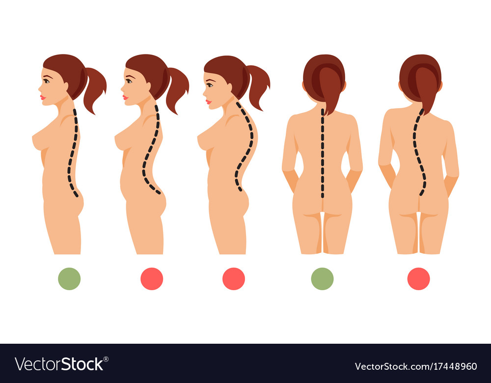 Types of curvature of the spine Royalty Free Vector Image