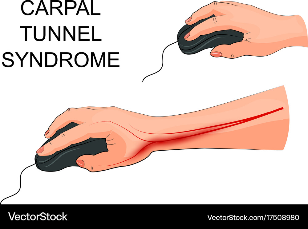 Carpal tunnel syndrome Royalty Free Vector Image