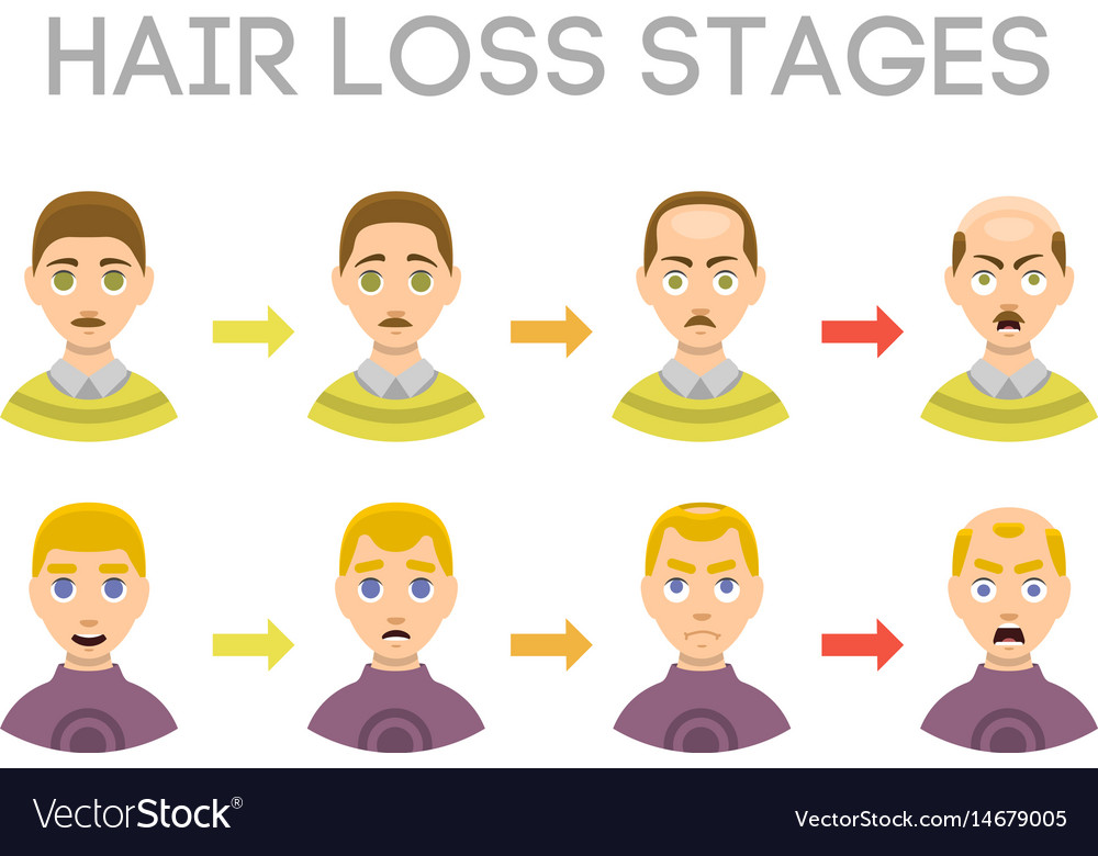 Information Chart Of Hair Loss Stages Types Of Vector Image