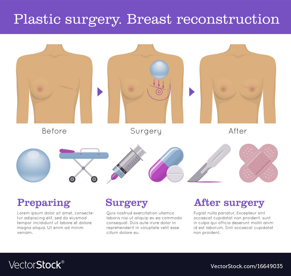 Breast plastic surgery.Vector Illustration. Stock Vector