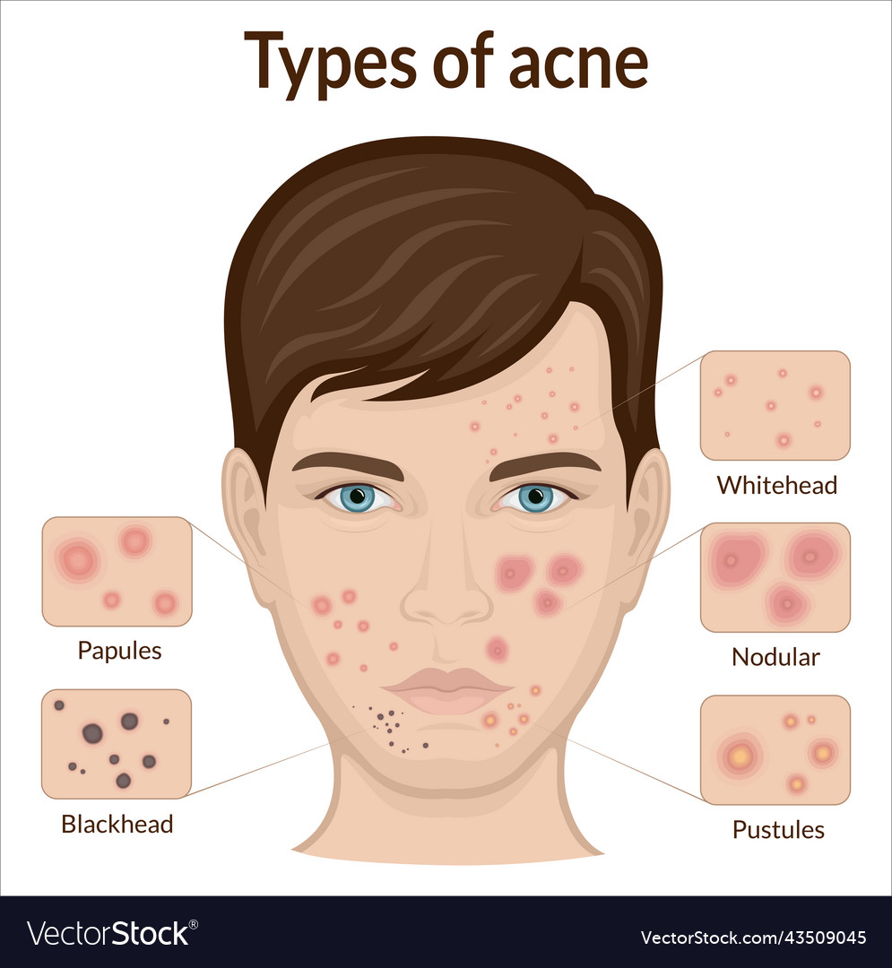 Types of acne Royalty Free Vector Image - VectorStock