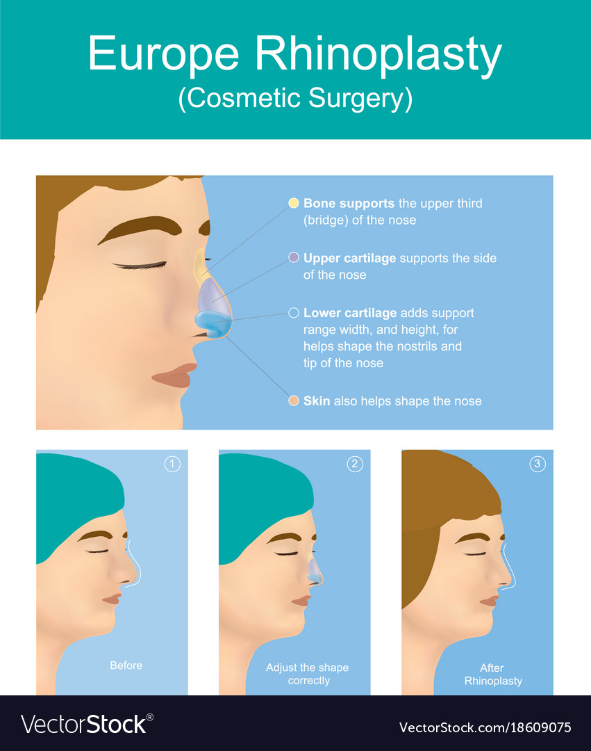 Rhinoplasty plastic surgery Royalty Free Vector Image