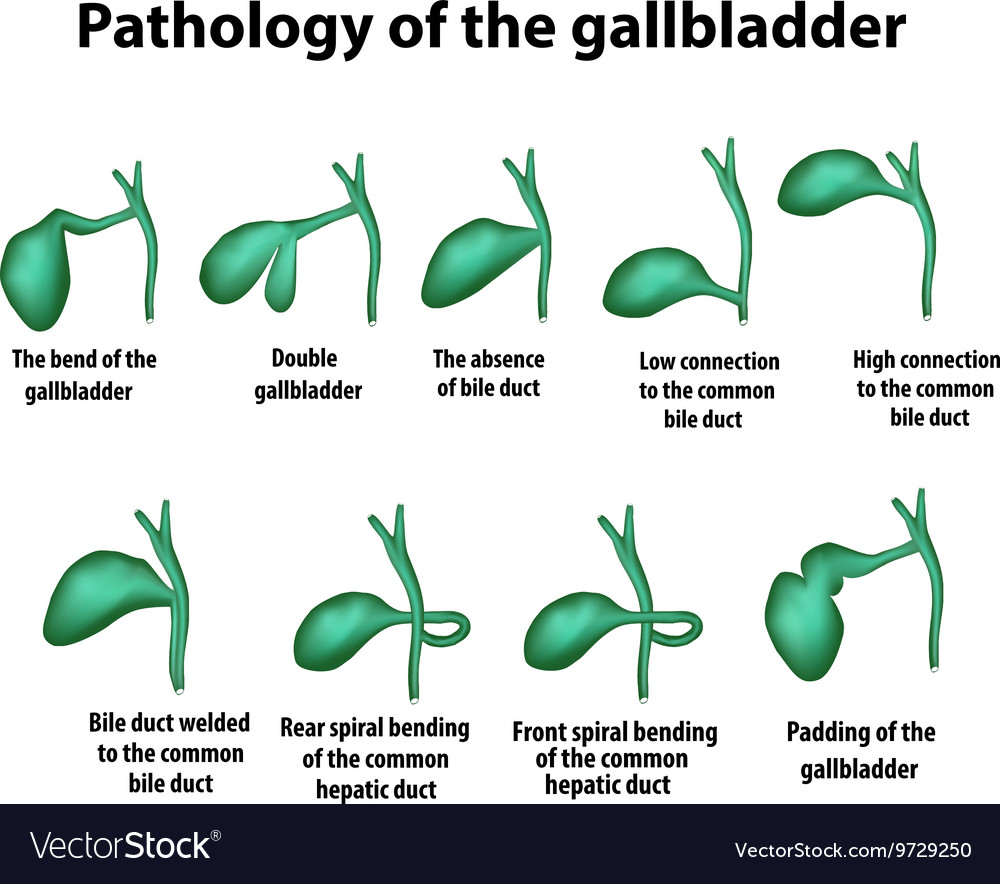 Pathology of the gallbladder the bend Royalty Free Vector