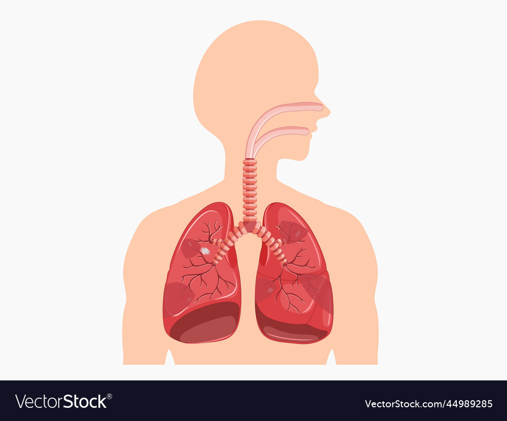 Asbestosis disease in lung for asbestos fibre