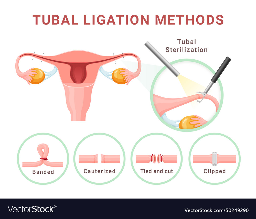 Tubal ligation methods female sterilization Vector Image