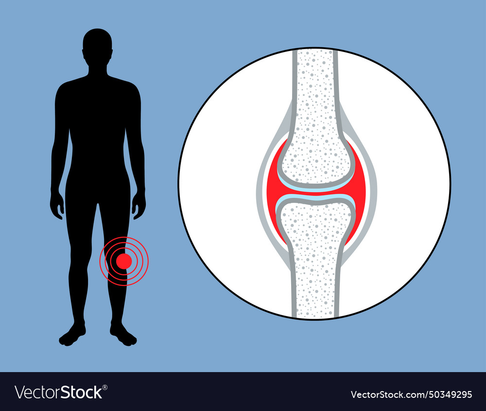 Hemarthrosis in the synovial joint Royalty Free Vector Image