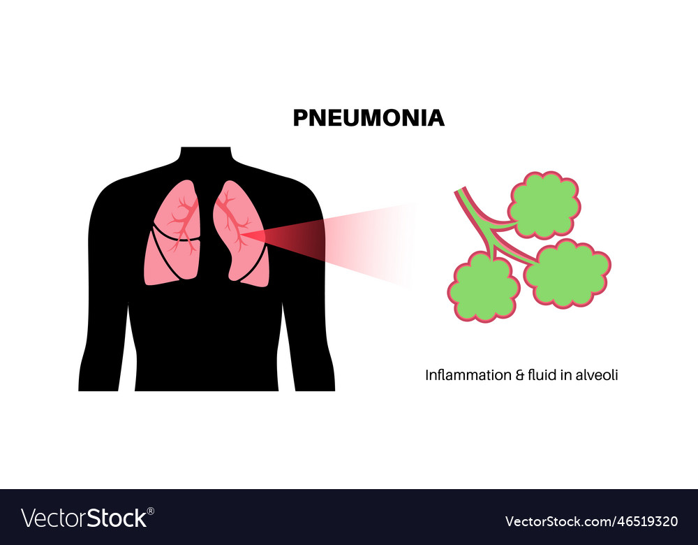 Pneumonia infection poster Royalty Free Vector Image