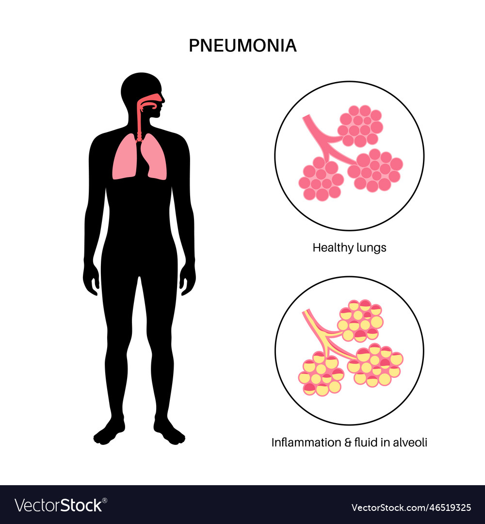 Pneumonia infection poster Royalty Free Vector Image