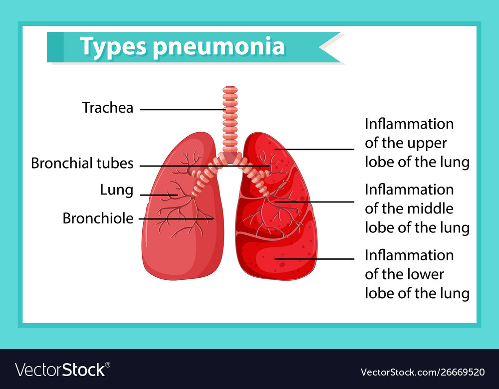 Scientific medical pneumonia Royalty Free Vector Image