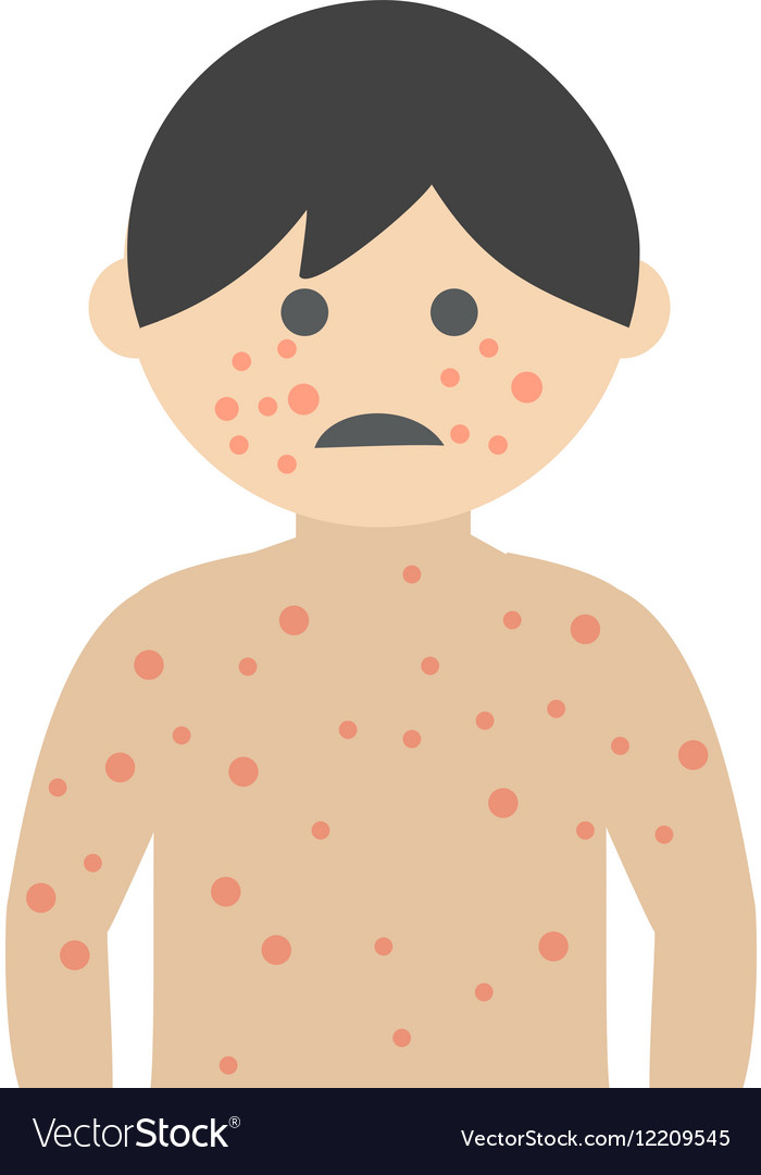 Image result for images of boy with measles