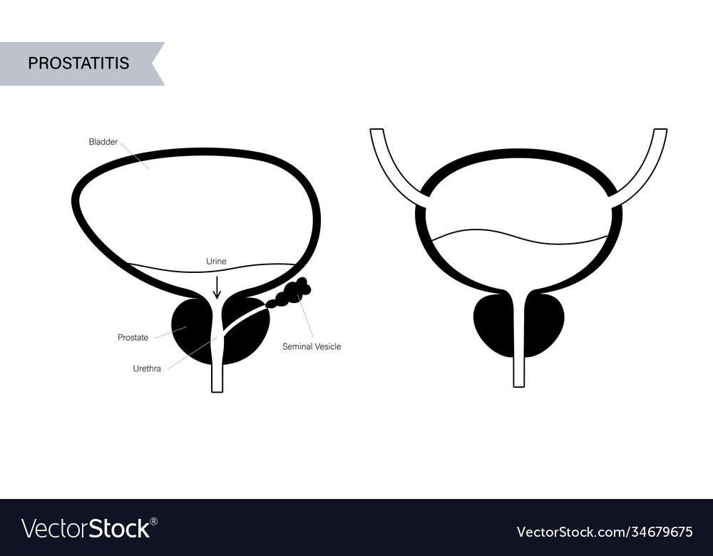 Prostatitis inflammation problem vector image Prostatitis inflammation problem