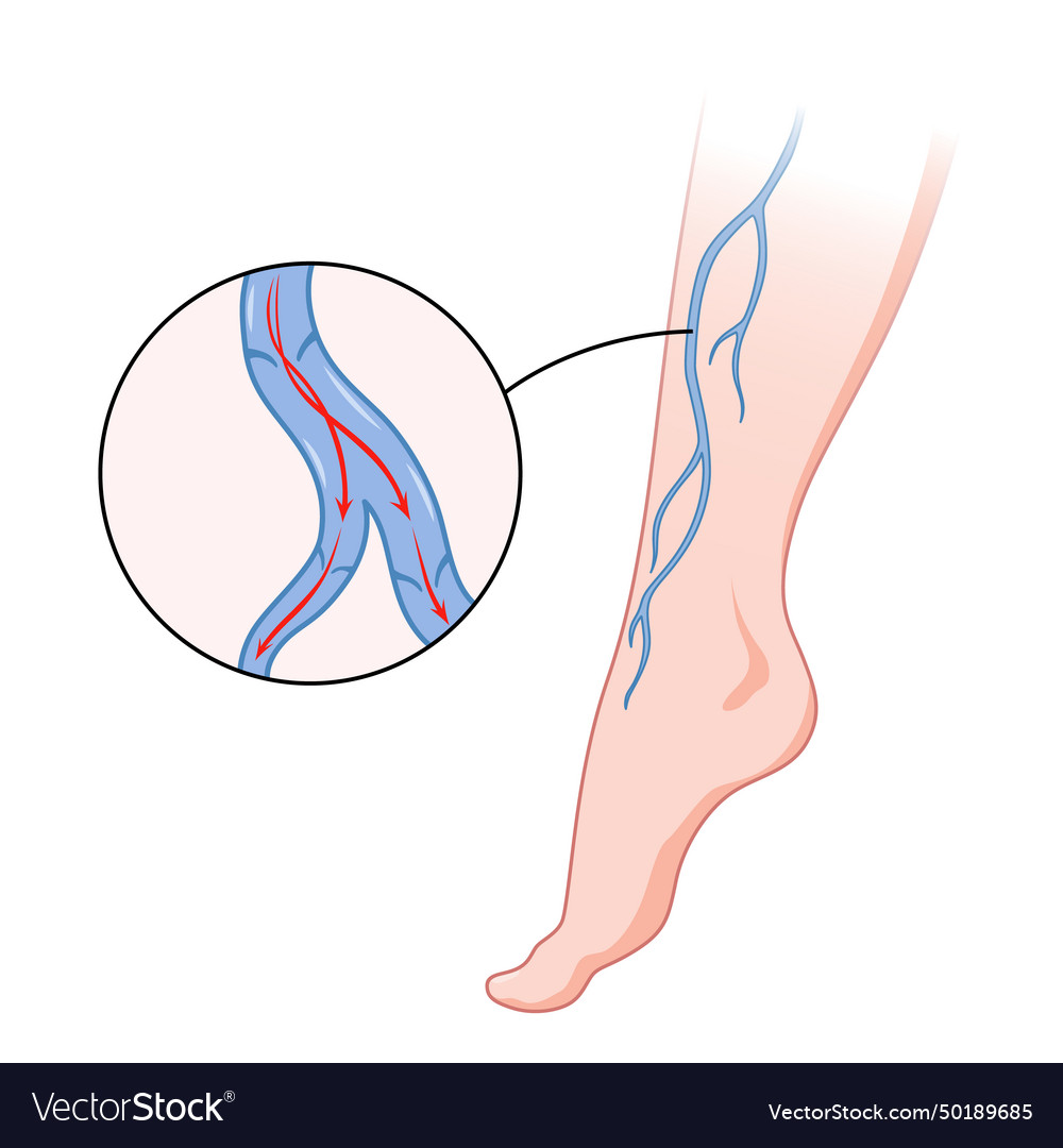 Varicose veins blue blood vessel visible through Vector Image