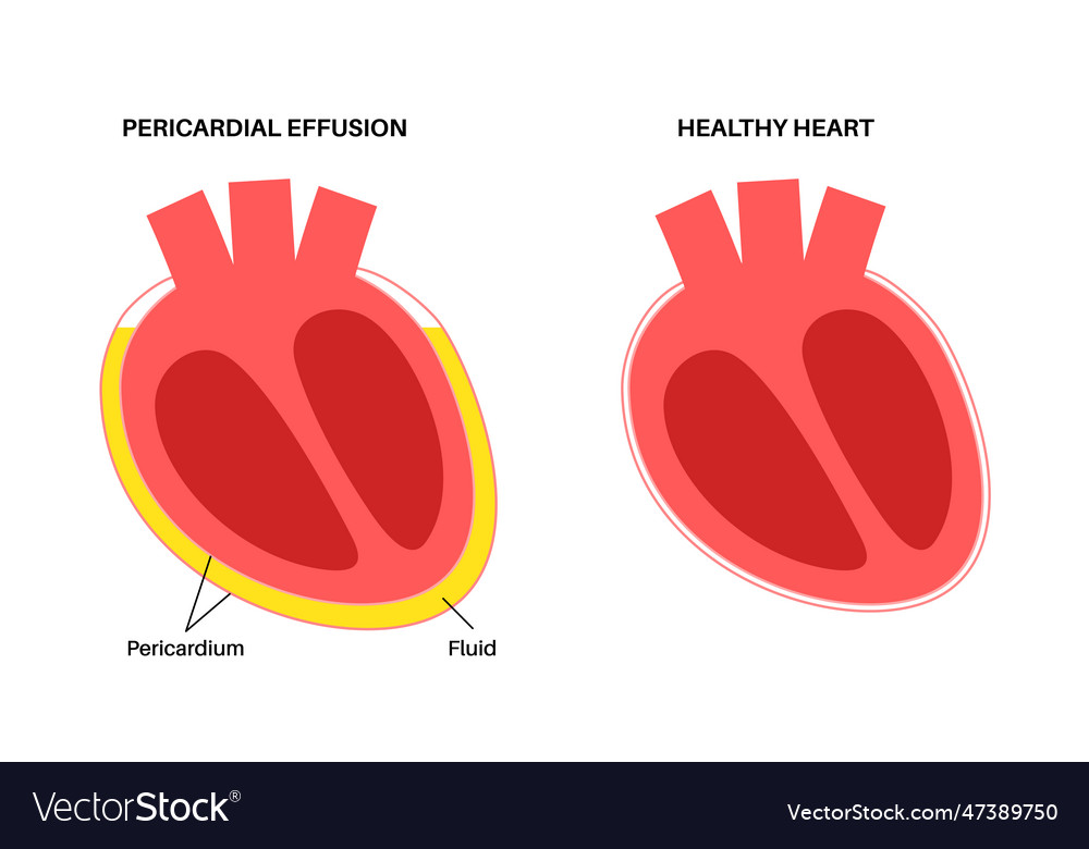 Pericardial effusion heart Royalty Free Vector Image