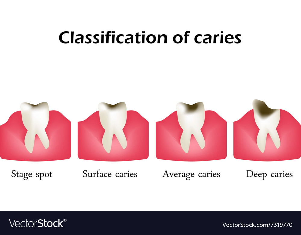 Types of dental caries infographics Royalty Free Vector