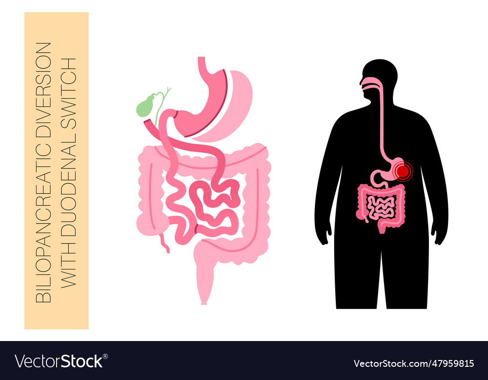 Biliopancreatic diversion procedure