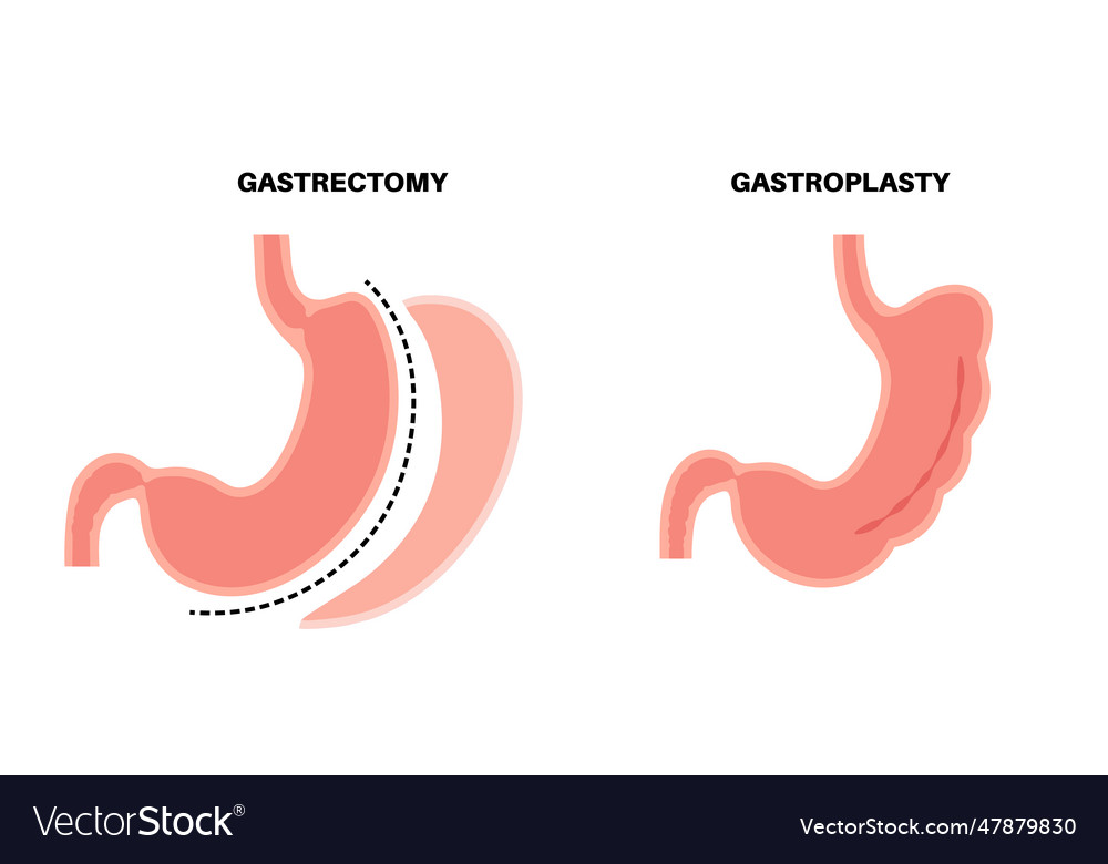 Gastrectomy and gastroplasty Royalty Free Vector Image