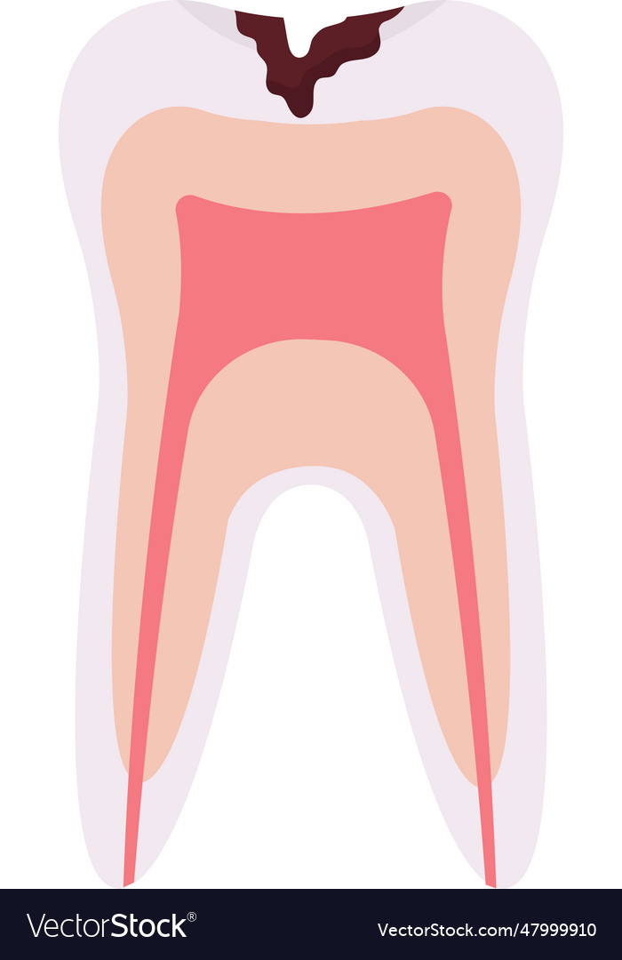 Deep caries tooth problem