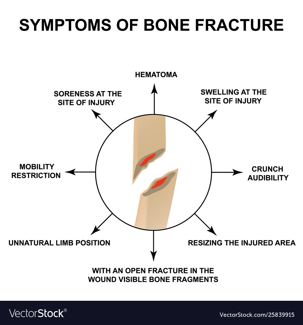 Symptoms Bone Fracture Bone Fracture Royalty Free Vector 5472