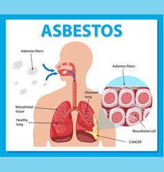 Diagram showing asbestosis in lungs Royalty Free Vector