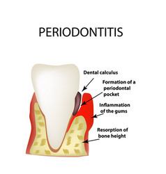 Periodontitis dental disease inflammation the Vector Image