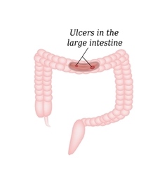 Ulcer Vector Images (over 680)