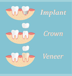 Teeth procedure crown restoration process Vector Image