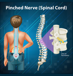 Diagram showing spinal cord injury in human Vector Image