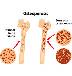 Osteoporosis Vector Images (over 4,400)