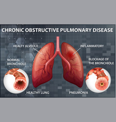 Chronic obstructive pulmonary disease Royalty Free Vector