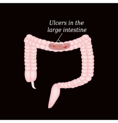 Ulcer in the intestine Ulcers in the colon Vector Image