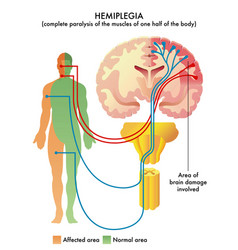 Causes hemiplegia Royalty Free Vector Image - VectorStock