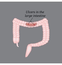 Ulcer in the intestine Ulcers in the colon Vector Image