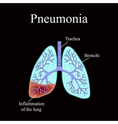 Pneumonia The anatomical structure of the human Vector Image