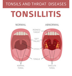 Tonsils and throat diseases tonsillitis symptoms Vector Image