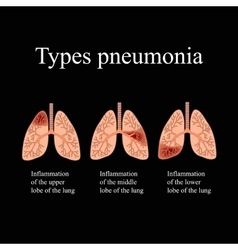 Pneumonia the anatomical structure human Vector Image