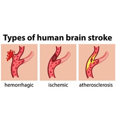 Types Of Human Brain Stroke Royalty Free Vector Image