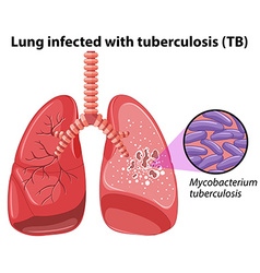 Scientific medical tuberculosis tb Royalty Free Vector Image